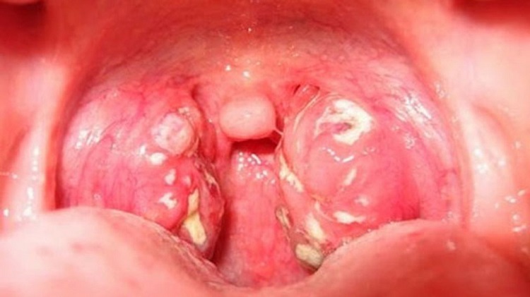 Viêm họng do liên cầu khuẩn có thể gặp một số biến chứng